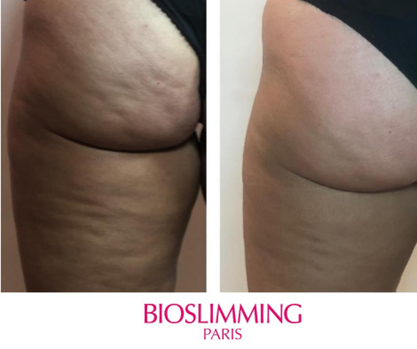 Bioslimming Resultaten